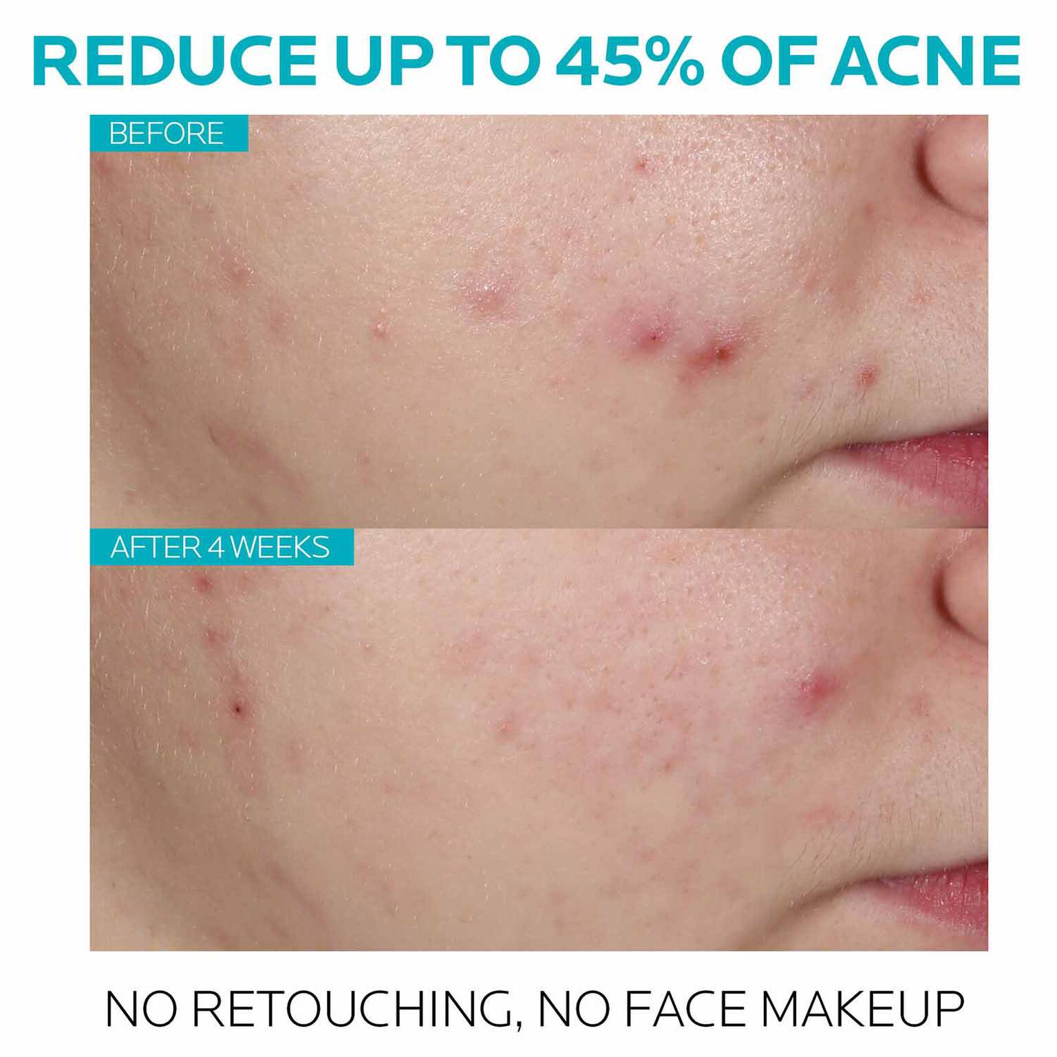 effaclar-salicylic-acid-acne-treatment-serum-c0 7_EffaclarSerum_After-45-days.jpg