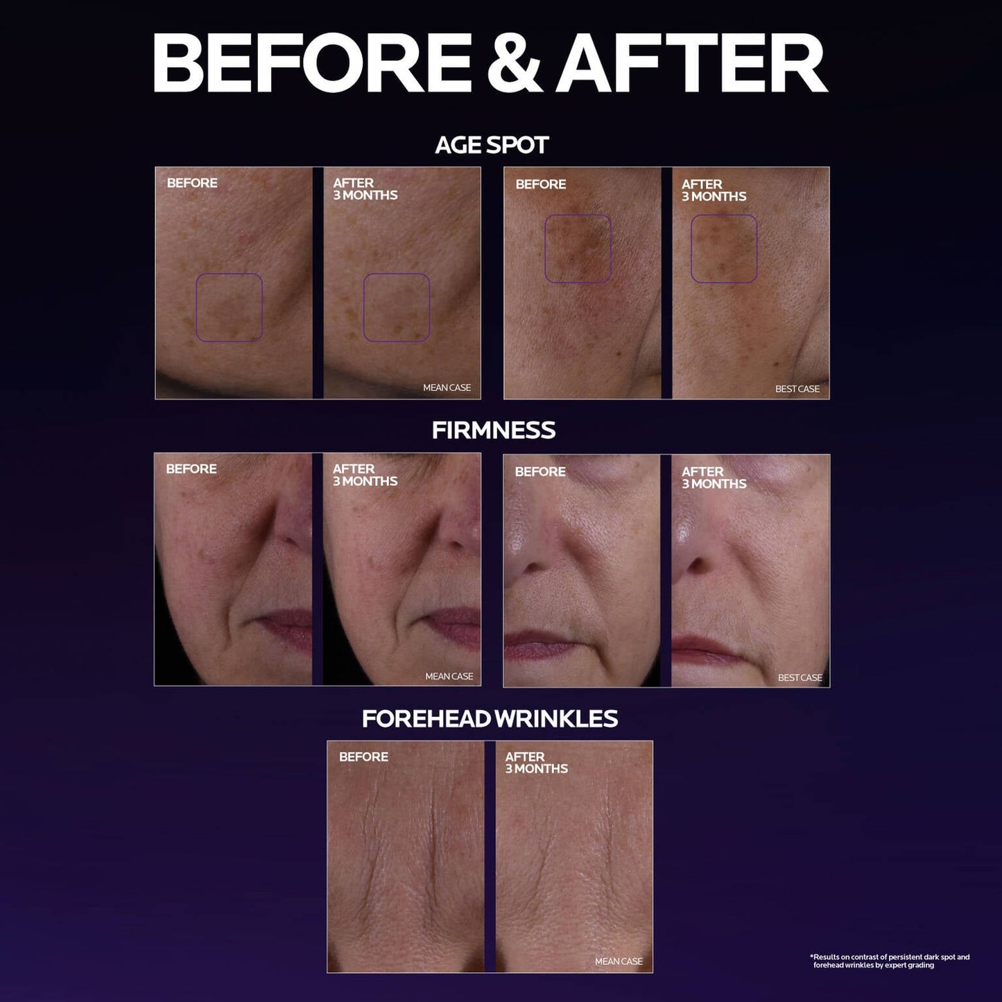 mela-b3-double-dose-discoloration-treatment-with-melasyltm-d6 MelaB3_DD_BTF_BeforeAfter_1500x1500_5.jpg