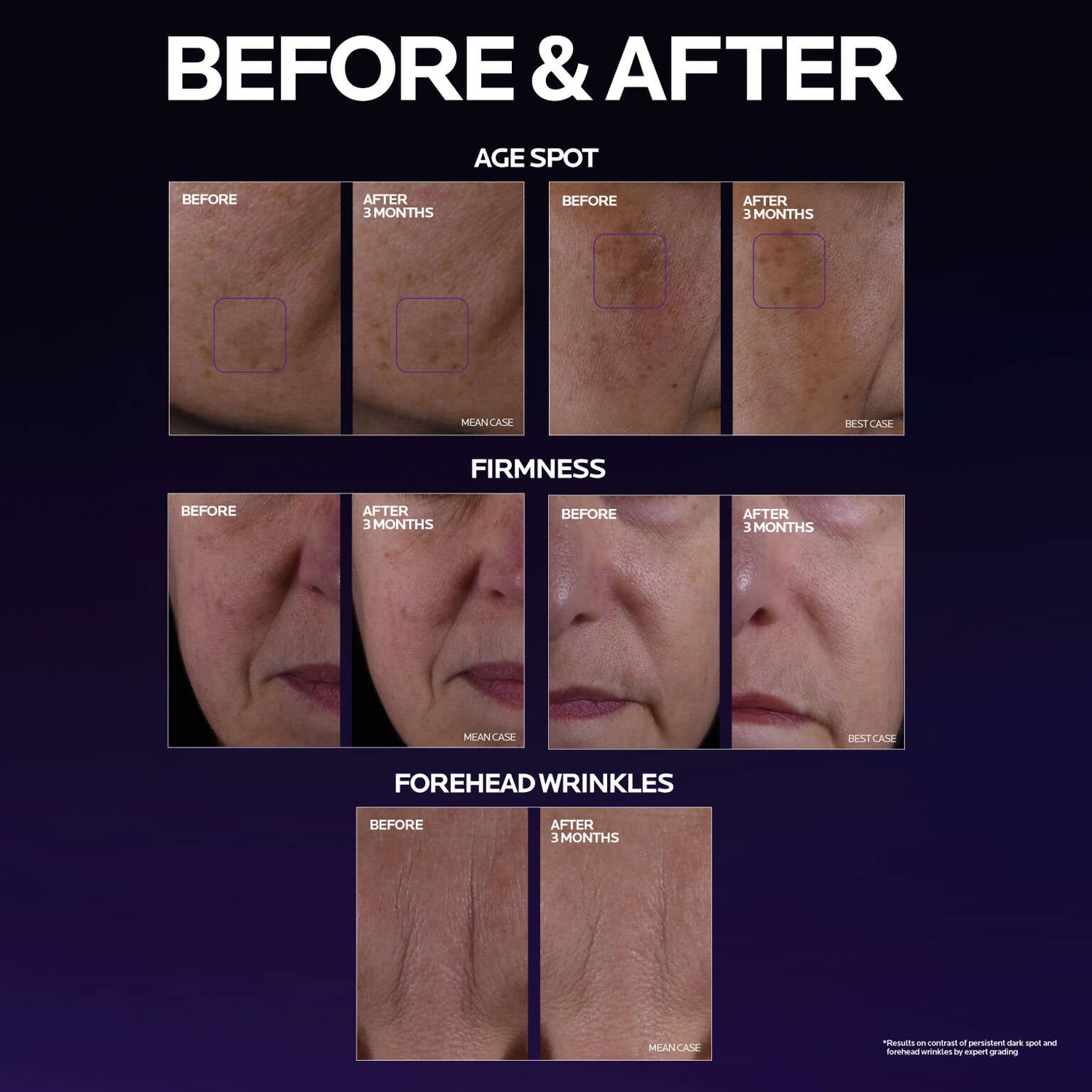 mela-b3-double-dose-discoloration-treatment-with-melasyltm-d6 MelaB3_DD_BTF_BeforeAfter_1500x1500_5.jpg